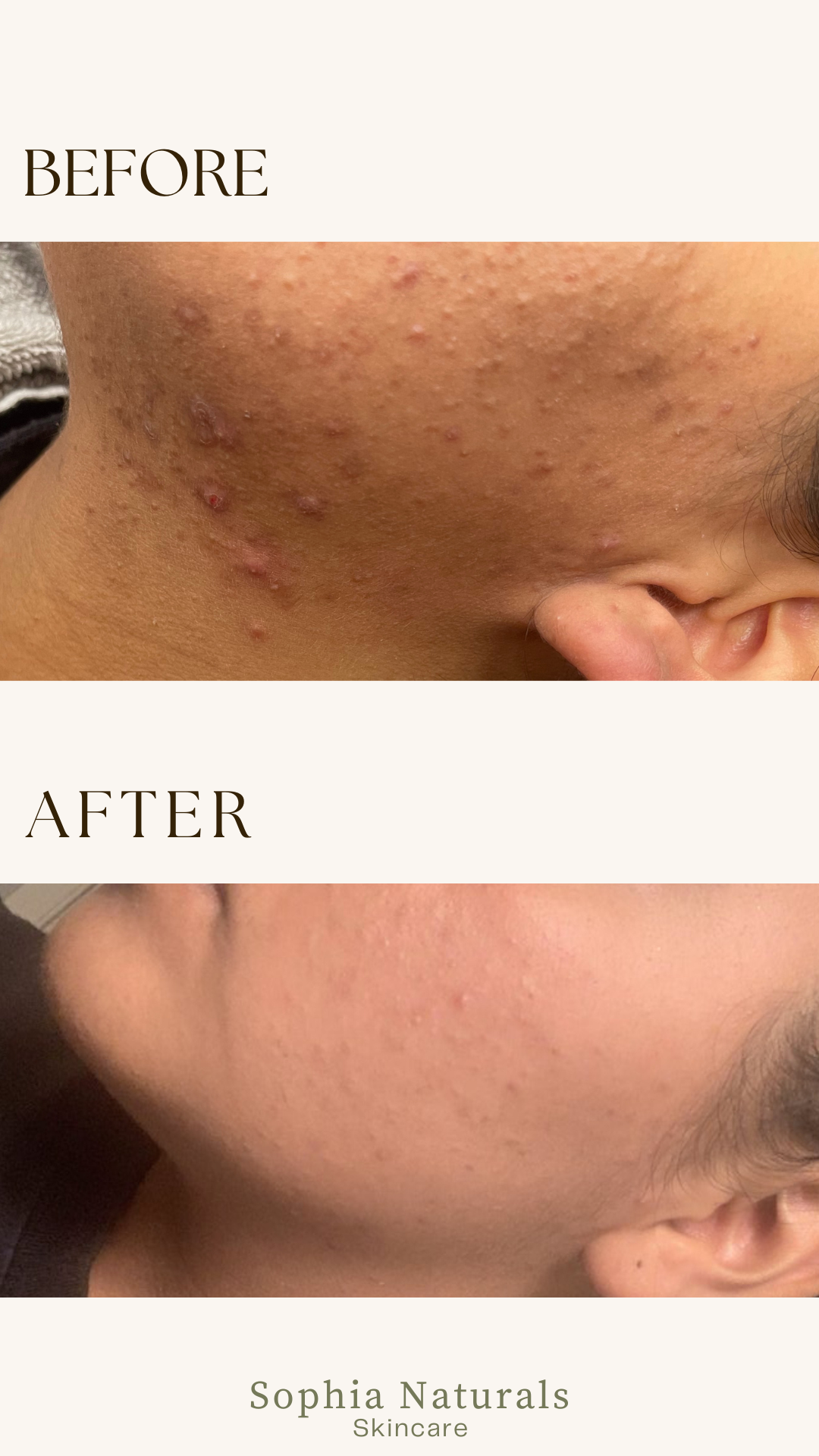 Visible skin transformation after organic skincare treatments at Sophia Naturals Skincare in Santa Clara, CA. Our customized holistic facials and handcrafted organic products help reduce acne, improve skin texture, brighten dark spots, and restore a healthy, glowing complexion. Trusted by clients across the Bay Area, Sophia Naturals specializes in natural skin healing, anti-aging facials, and personalized skincare solutions.