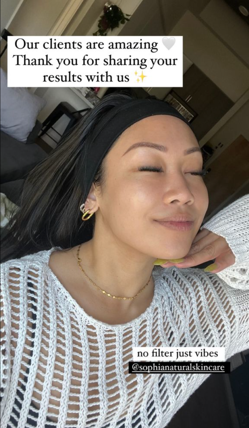 This client experienced an incredible skin transformation after customized organic facials and handcrafted skincare at Sophia Naturals Skincare in Santa Clara, CA. Her skin is now clearer, smoother, and glowing thanks to our holistic treatments and natural products. Trusted by clients across the Bay Area for personalized facials and visible results.