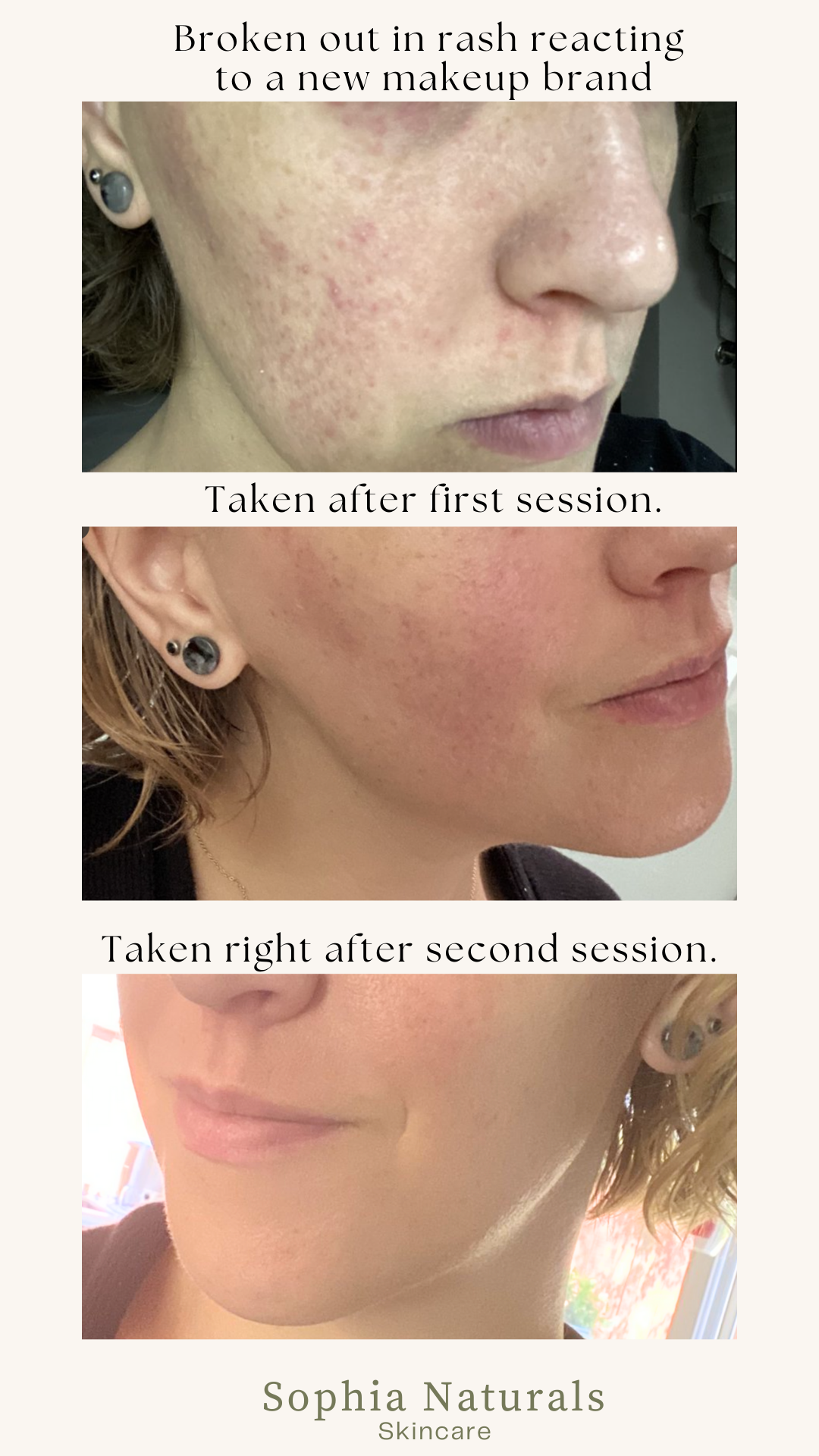 This client experienced an incredible skin transformation after customized organic facials and handcrafted skincare at Sophia Naturals Skincare in Santa Clara, CA. Her skin is now clearer, smoother, and glowing thanks to our holistic treatments and natural products. Trusted by clients across the Bay Area for personalized facials and visible results. After using a bad makeup brand, her skin broke out, our skincare helped her, photos show transformation