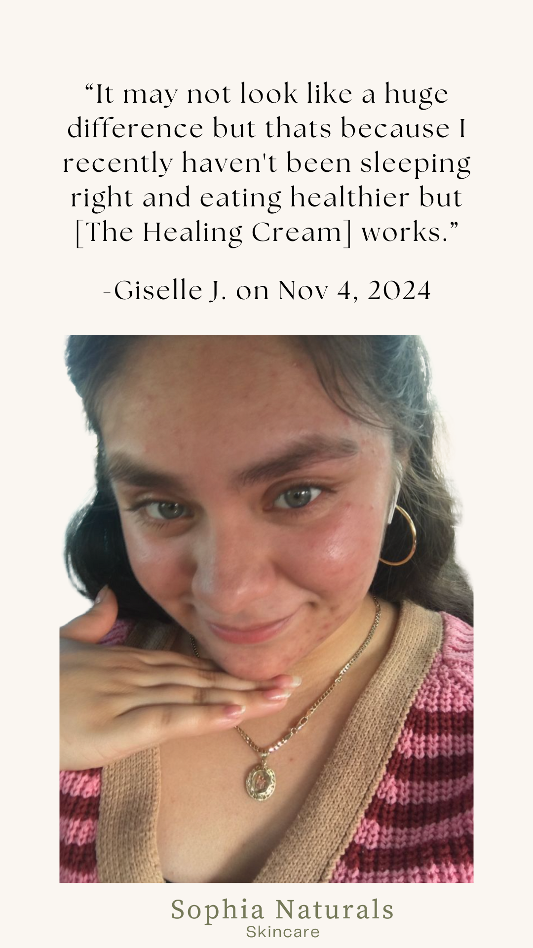 Visible skin transformation after organic skincare treatments at Sophia Naturals Skincare in Santa Clara, CA. Our customized holistic facials and handcrafted organic products help reduce acne, improve skin texture, brighten dark spots, and restore a healthy, glowing complexion. Trusted by clients across the Bay Area, Sophia Naturals specializes in natural skin healing, anti-aging facials, and personalized skincare solutions.
