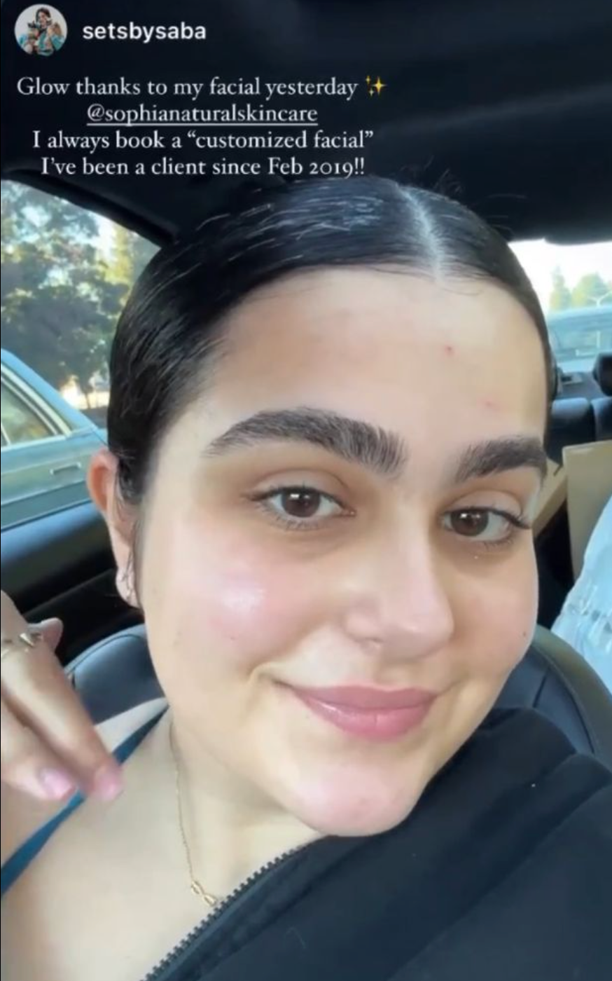 This client experienced an incredible skin transformation after customized organic facials and handcrafted skincare at Sophia Naturals Skincare in Santa Clara, CA. Her skin is now clearer, smoother, and glowing thanks to our holistic treatments and natural products. Trusted by clients across the Bay Area for personalized facials and visible results.