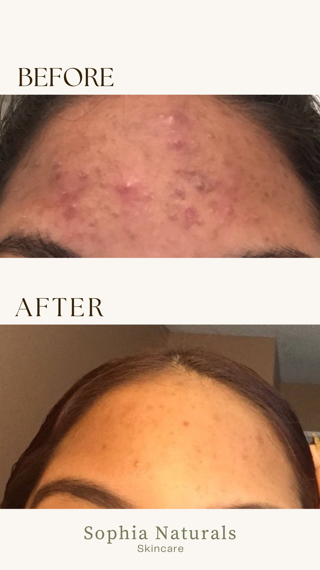 Visible skin transformation after organic skincare treatments at Sophia Naturals Skincare in Santa Clara, CA. Our customized holistic facials and handcrafted organic products help reduce acne, improve skin texture, brighten dark spots, and restore a healthy, glowing complexion. Trusted by clients across the Bay Area, Sophia Naturals specializes in natural skin healing, anti-aging facials, and personalized skincare solutions.