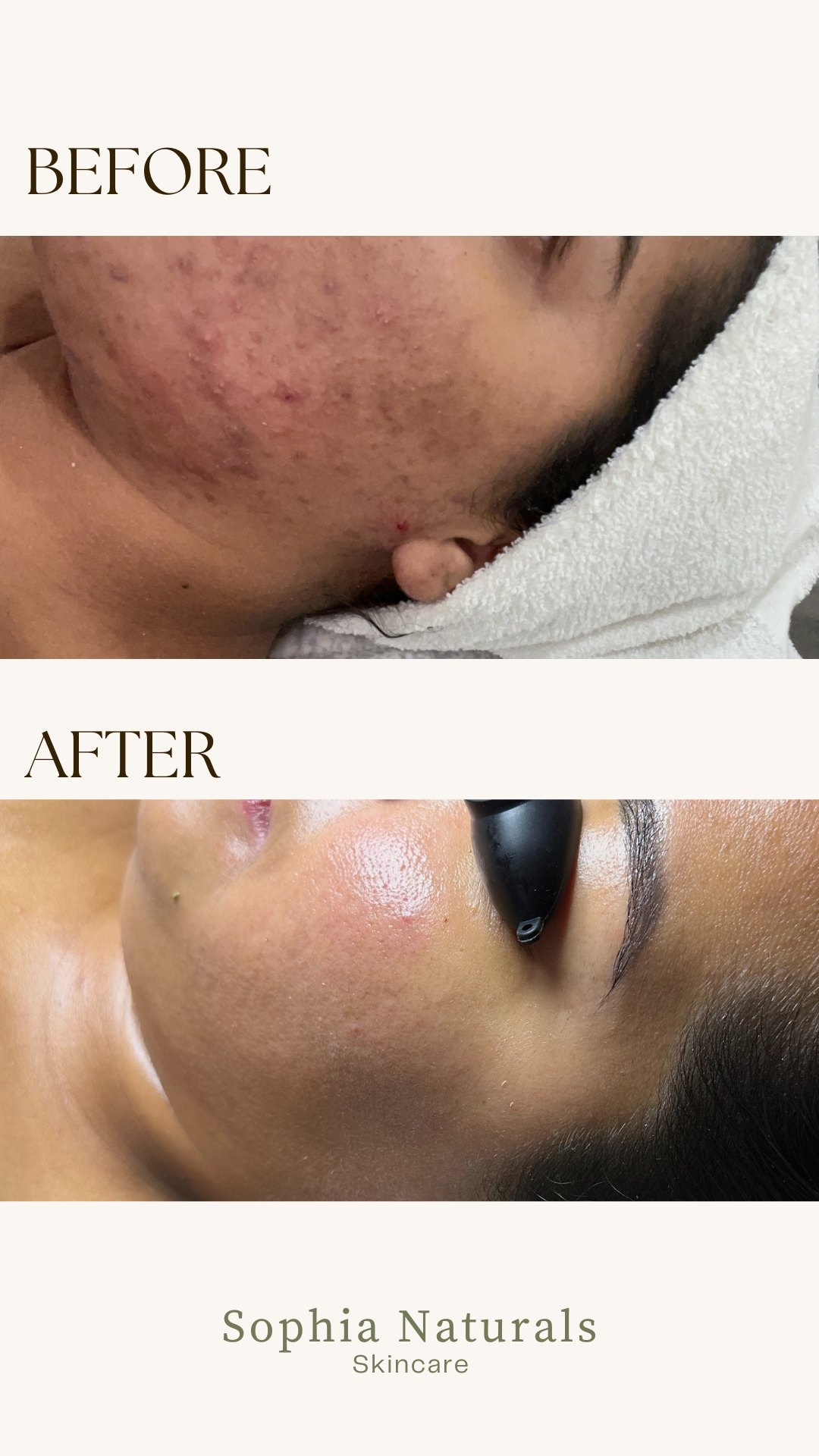 Visible skin transformation after organic skincare treatments at Sophia Naturals Skincare in Santa Clara, CA. Our customized holistic facials and handcrafted organic products help reduce acne, improve skin texture, brighten dark spots, and restore a healthy, glowing complexion. Trusted by clients across the Bay Area, Sophia Naturals specializes in natural skin healing, anti-aging facials, and personalized skincare solutions.